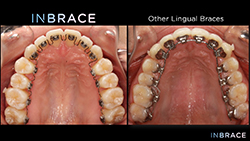 INBRACE